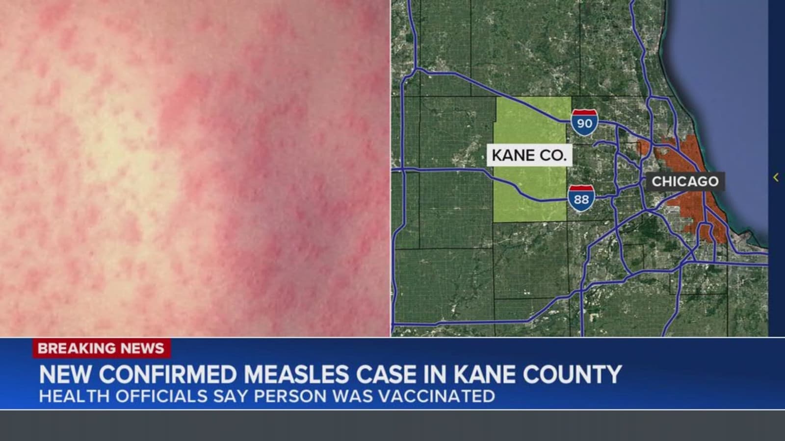 Kane County Confirms Second Measles Case Tied to Kaneland High School